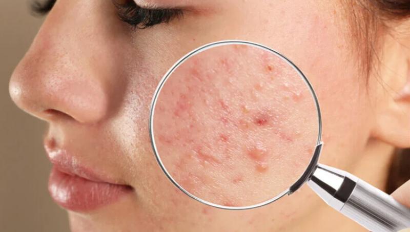 Ayurveda for ACNE