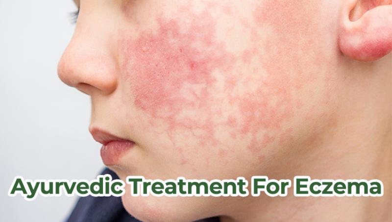 Eczema Treatment in Ayurveda