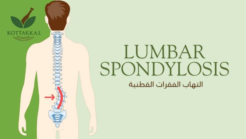 LUMBAR SPONDYLOSIS