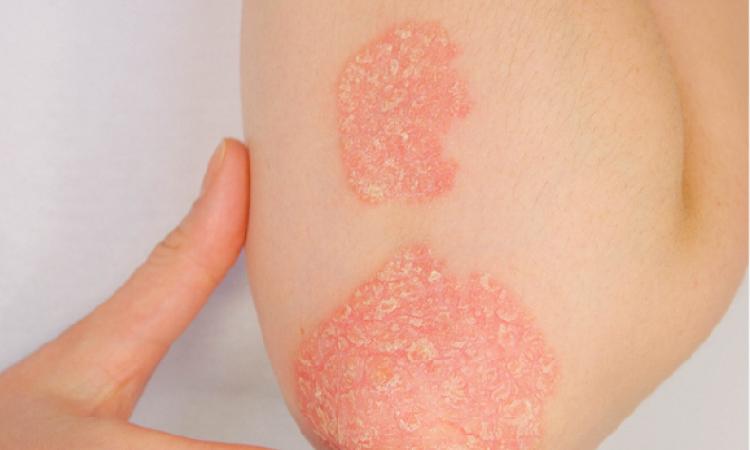 Psoriasis